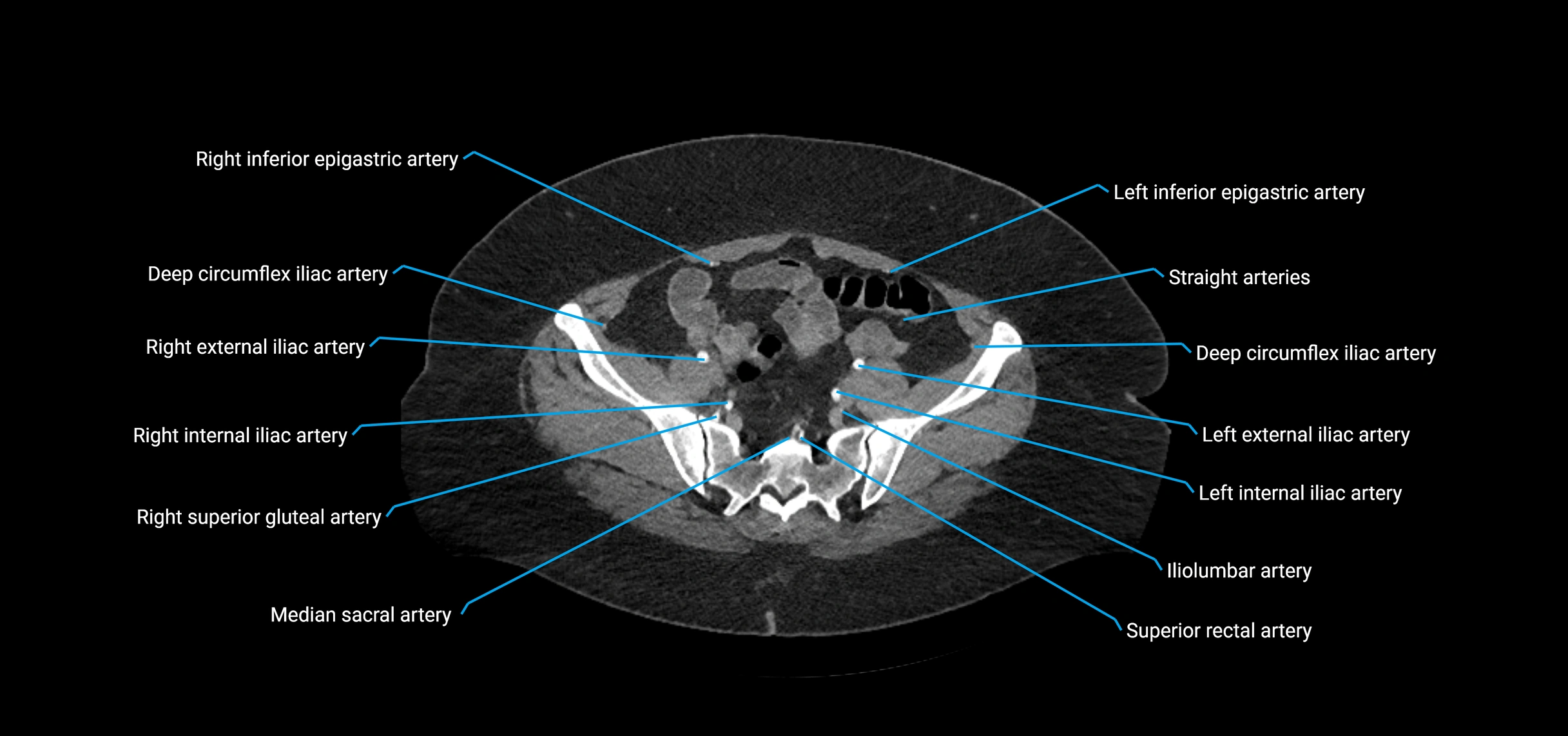 CTA abdomen axial cross sectional anatomy labelled image_197 (2).webp
